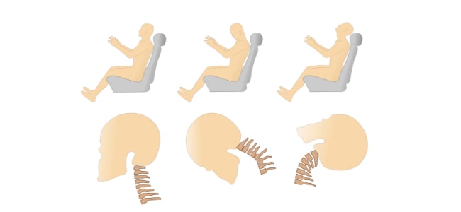 交通事故で首を痛めた際のむちうち図解
