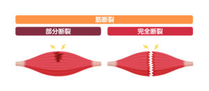 肉離れの部分断裂と完全断裂の画像