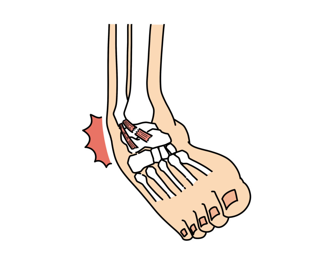 整骨院でよくみる足首の捻挫