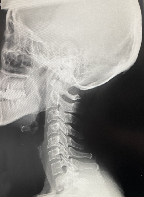 首の整形外科のレントゲン検査
