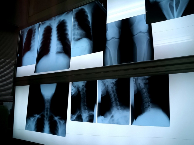 骨折の種類をレントゲン検査で診察